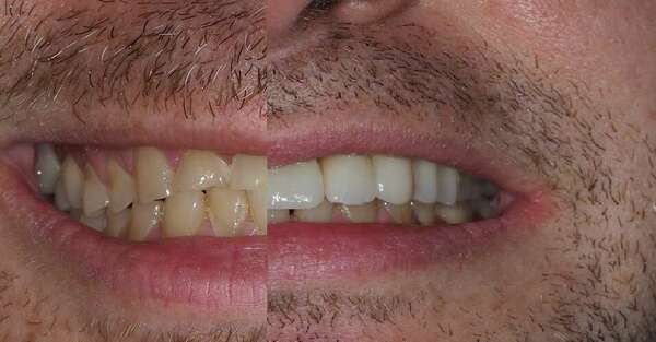 Cas du mois - Bruxisme intense