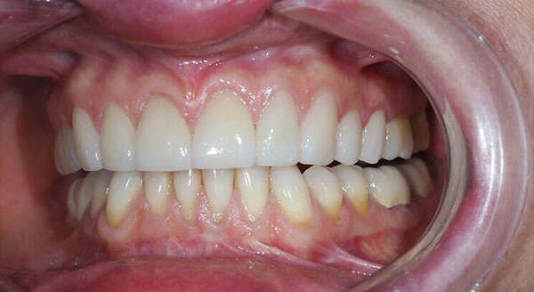 Cas du mois - Embellissement du sourire par des facettes céramiques