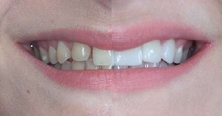 Cas du mois - Transformation de canines en latérales