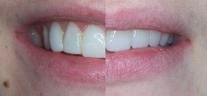 Cas du mois - Réfection de 6 facettes