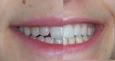 Cas du mois - Espaces interdentaires et facettes dentaires