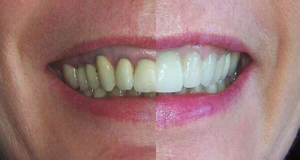 Cas du mois - Remplacement de couronnes anciennes