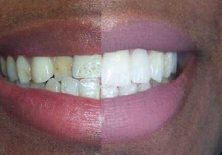 Cas du mois - Défauts de l'émail et facettes collées