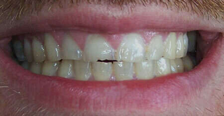 Usures importantes des dents dues au bruxisme – cas clinique, photo 1 sur 12 – Dr Nadine Assayag, Paris 16
