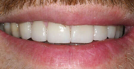 Usures importantes des dents dues au bruxisme – cas clinique, photo 2 sur 12