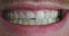 Usures importantes des dents dues au bruxisme – cas clinique, photo 3 sur 12