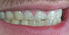 Usures importantes des dents dues au bruxisme – cas clinique, photo 4 sur 12