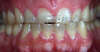 Usures importantes des dents dues au bruxisme – cas clinique, photo 5 sur 12