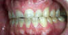 Usures importantes des dents dues au bruxisme – cas clinique, photo 6 sur 12