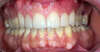 Usures importantes des dents dues au bruxisme – cas clinique, photo 7 sur 12