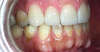 Usures importantes des dents dues au bruxisme – cas clinique, photo 8 sur 12