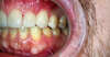 Usures importantes des dents dues au bruxisme – cas clinique, photo 9 sur 12