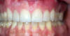 Usures importantes des dents dues au bruxisme – cas clinique, photo 10 sur 12