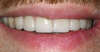Usures importantes des dents dues au bruxisme – cas clinique, photo 11 sur 12
