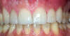 Usures importantes des dents dues au bruxisme – cas clinique, photo 12 sur 12
