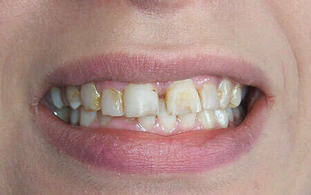 Réhabilitation du sourire par facettes collées en céramique – cas clinique, photo 1 sur 9 – Dr Nadine Assayag, Paris 16