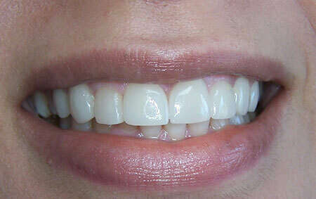 Réhabilitation du sourire par facettes collées en céramique – cas clinique, photo 2 sur 9