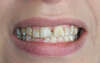 Réhabilitation du sourire par facettes collées en céramique – cas clinique, photo 3 sur 9