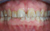 Réhabilitation du sourire par facettes collées en céramique – cas clinique, photo 4 sur 9