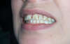 Réhabilitation du sourire par facettes collées en céramique – cas clinique, photo 5 sur 9