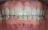 Réhabilitation du sourire par facettes collées en céramique – cas clinique, photo 6 sur 9