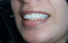 Réhabilitation du sourire par facettes collées en céramique – cas clinique, photo 7 sur 9