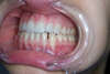 Espaces interdentaires et facettes dentaires – cas clinique, photo 4 sur 7