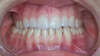 Espaces interdentaires et facettes dentaires – cas clinique, photo 5 sur 7