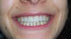 Espaces interdentaires et facettes dentaires – cas clinique, photo 7 sur 7