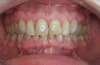 Éclaircissement des dents par facettes en céramique – cas clinique, photo 1 sur 6 – Dr Nadine Assayag, Paris 16