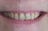 Éclaircissement des dents par facettes en céramique – cas clinique, photo 2 sur 6