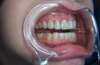 Éclaircissement des dents par facettes en céramique – cas clinique, photo 4 sur 6