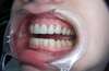 Éclaircissement des dents par facettes en céramique – cas clinique, photo 5 sur 6