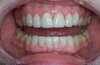 Éclaircissement des dents par facettes en céramique – cas clinique, photo 6 sur 6