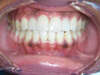 Défauts de l'émail et facettes collées – cas clinique, photo 5 sur 9