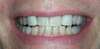 Traitement du sourire en 2 séances – cas clinique, photo 1 sur 10 – Dr Nadine Assayag, Paris 16