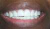 Traitement par facettes dentaires – cas clinique, photo 1 sur 6 – Dr Nadine Assayag, Paris 16