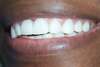 Traitement par facettes dentaires – cas clinique, photo 2 sur 6