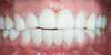 Traitement par facettes dentaires – cas clinique, photo 3 sur 6