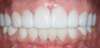 Traitement par facettes dentaires – cas clinique, photo 4 sur 6