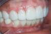 Traitement par facettes dentaires – cas clinique, photo 5 sur 6