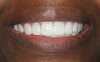 Traitement par facettes dentaires – cas clinique, photo 6 sur 6