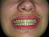 Gouttières transparentes, invisalign