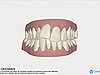 Gouttières transparentes, invisalign