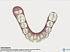 Gouttières transparentes, invisalign