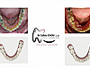 Gouttières transparentes, invisalign