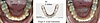 Gouttières transparentes, invisalign