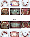 Cas traités en Invisalign