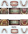 Cas traités en Invisalign