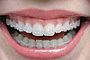 Bagues extérieures céramiques (blanches)